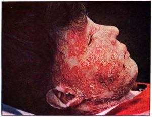 상피종을 동반한 얼굴 전체에 광범위하게 나타나는 루푸스 반점