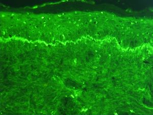 직접 면역형광을 위해 항-IgG 항체를 사용하여 준비된 인간 피부의 조직학적 절편 현미경 사진. 피부는 전신 홍반성 루푸스 환자에게서 얻은 것으로, 두 곳에서 IgG 침착을 보인다. 첫 번째는 표피 기저막을 따라 띠 모양으로 침착된 것("루푸스 밴드 검사" 양성); 두 번째는 표피 세포의 핵 내에 있다(항핵 항체가 존재).