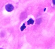 호산구의 조직학적 구조, 희미하게 보이는 호산성 세포질에도 불구하고 이엽 핵을 특징으로 하는 상피 내 호산구