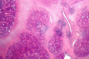 현미경 사진으로 본 만성 타액선염 상태의 침샘. 만성적인 염증 소견을 보인다.