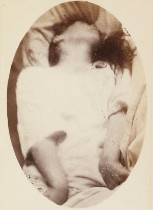 전신 발작의 정지 이미지