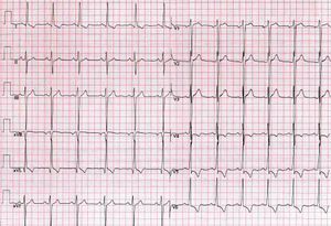 좌심실 비대증의 EKG 묘사