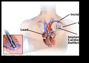 이식형 제세동기 (ICD) 그림