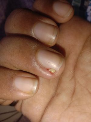 손가락에서 피와 함께 나오는 고름