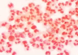 그람 음성 임균과 고름 세포