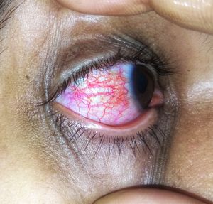 바이러스성 결막염