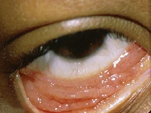 클라미디아 결막염을 앓고 있는 눈