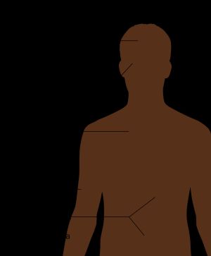 후천면역결핍증후군(AIDS)의 증상