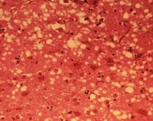 소해면상뇌병증에 감염된 소의 뇌 조직에서 관찰되는 해면 모양의 공포(空胞).출처: 미국 동식물검역소(APHIS)