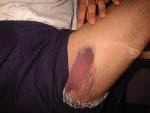 난간에 부딪혀 생긴 멍, 스케이트보드와 인라인 스케이트와 같은 익스트림 스포츠에서 흔히 발생한다.