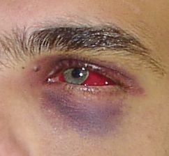 얼굴에 주먹을 맞은 후 생긴 멍든 눈과 결막하 출혈