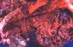 흉막강 전체를 채우고 있는 대량의 혈흉. 혈액이 굳은 상태이다. 부검 표본.