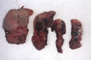 치핵의 육안 병리로, 울혈된 혈관을 보여준다.