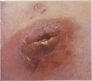 종기 근접 사진, 괴사와 탈락이 보임