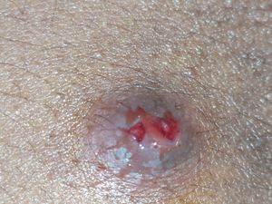 자연적으로 배농된 농양