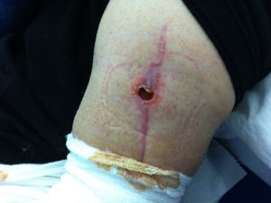 소파술 후 농양