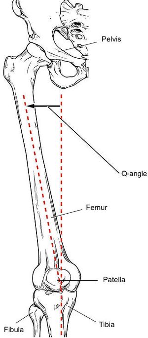 Q각이 있는 대퇴골: 전상장골극에서 슬개골 중앙을 지나 슬개골 중앙에서 경골 조면 중앙으로 그은 선이 이루는 각도