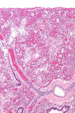 ARDS의 조직학적 소견인 미만성 폐포 손상. H&E 염색.