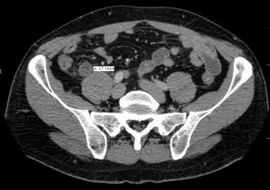급성 충수염 CT 스캔 (충수 지름 17.1mm, 주변 염증 확인)