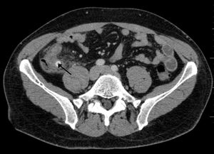 급성 충수염을 유발한 분변석 (화살표)
