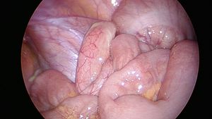 오른쪽 엉덩뼈 오목에 위치한 섬유성 플라크가 있는 화농성 맹장 충수의 복강경 시야