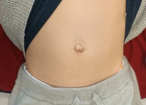 소아 환자의 복강경 보조 경복부 충수 절제술 흉터. 수술 후 1개월의 마취 결과.