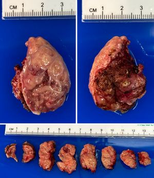 비대해진 신선한 편도의 육안 병리학. 왼쪽 상단: 상기도를 향한 표면. 오른쪽 상단: 반대 표면(소작). 하단: 절단면.