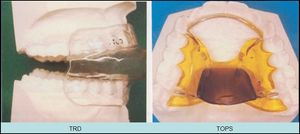 하악 전방 이동 장치