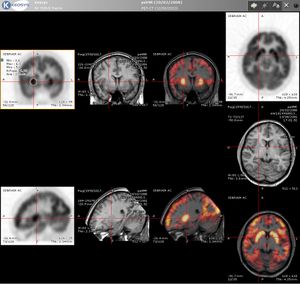 뇌 PET-MRI 융합 영상