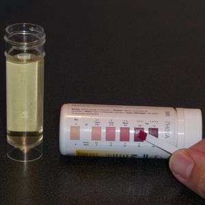 바이엘 케토스틱스 시약을 사용한 케톤뇨증 검사