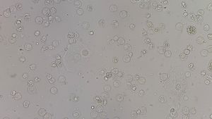 소변 내 편평 상피 세포, 백혈구 및 적혈구를 보여주는 광학 현미경 이미지. 세균도 관찰됨.