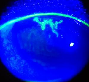 코발트 블루 조명 하에서 형광 염색 후 보이는 수지상 각막 궤양