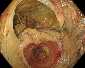 문합 부위가 제대로 아물지 않아 내용물이 새는 문합 누출의 예시