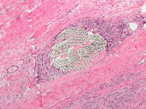 현미경 사진에서 H&E 염색된 조직 절편이 주변 이물 거대 세포 반응과 함께 비흡수성 다중 필라멘트 외과용 봉합사를 보여준다.