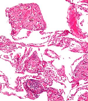 정맥 주사 약물 사용으로 인한 폐 활석증. H&E 염색.