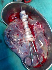 후산 후 신생아에게서도 잘라낸 태반과 탯줄.