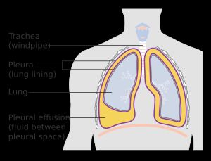 가슴막 삼출은 가슴막안(pleural space로 표시됨)에 체액이 고일 때 발생할 수 있다.