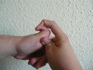 EDS를 가지는 사람의 과운동 관절