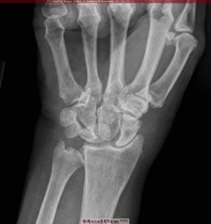 불안정한 손목의 X-ray