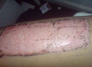 피부 제거 8일 후 분할 두께 피부 이식 공여 부위