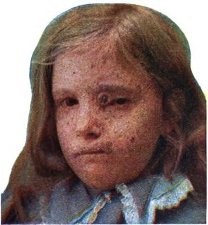 눈꺼풀과 입에 상피종이 나타난 색소성 건피증을 앓는 소녀