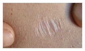 엘러스-단로스 증후군 환자의 위축성 "담배 종이" 흉터