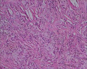 황색종의 조직학적 사진, 지질이 풍부한 거품 세포와 큰 콜레스테롤 열극을 보여준다, 10배 확대, 에오신 및 헤마톡실린 염색