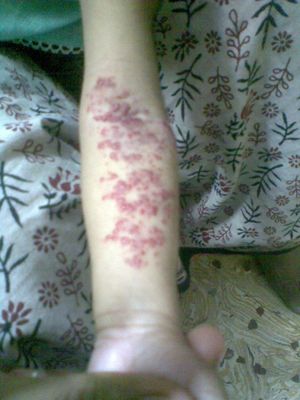 어린이 팔의 혈관종