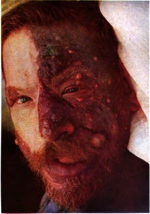 입술과 혀를 포함하여 얼굴의 절반을 덮고 있는 혈관종