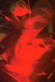 광역학 치료 시술 모습