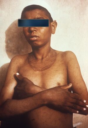 펠라그라로 인한 목 주위의 카잘 칼라 발진이 나타난 어린이