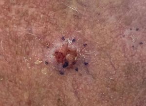 생검을 위해 표시된 우측 뺨의 기저 세포 암종