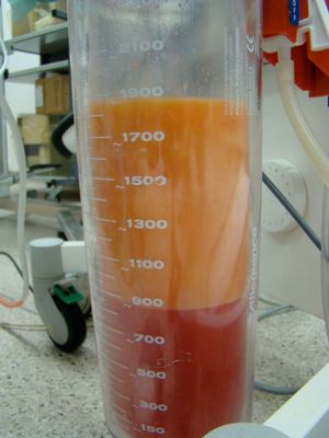 지방흡입술 흡입물