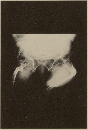 골형성부전증 환자의 엉덩이 X-레이 사진, 낮은 골밀도를 보여줌